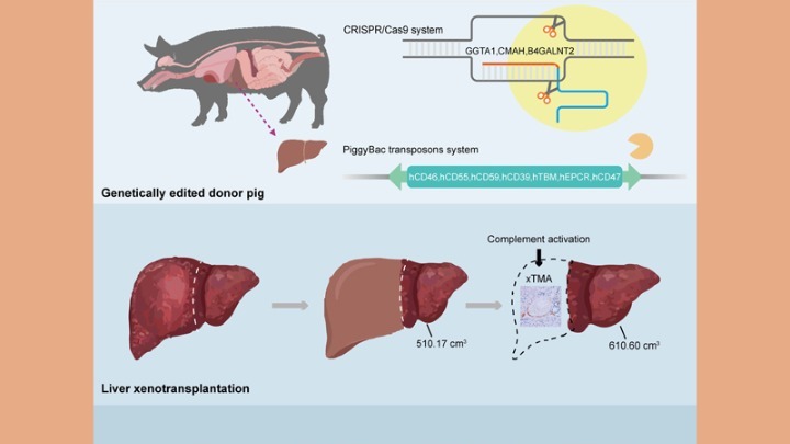 Πρωτοποριακή Ξενομεταμόσχευση Ηπατος από Χοίρο σε Άνθρωπο: Νέοι Δρόμοι στην Ιατρική